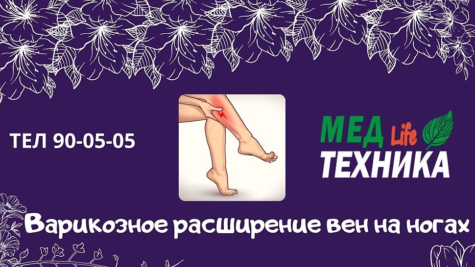 Варикозное расширение вен на ногах