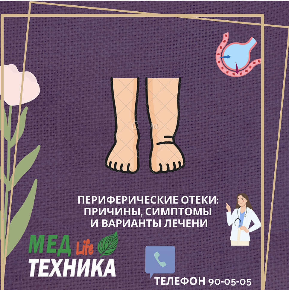 Периферические отеки: причины, симптомы и варианты лечения