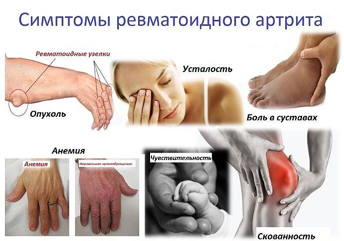 5 рекомендаций по лечению артрита.