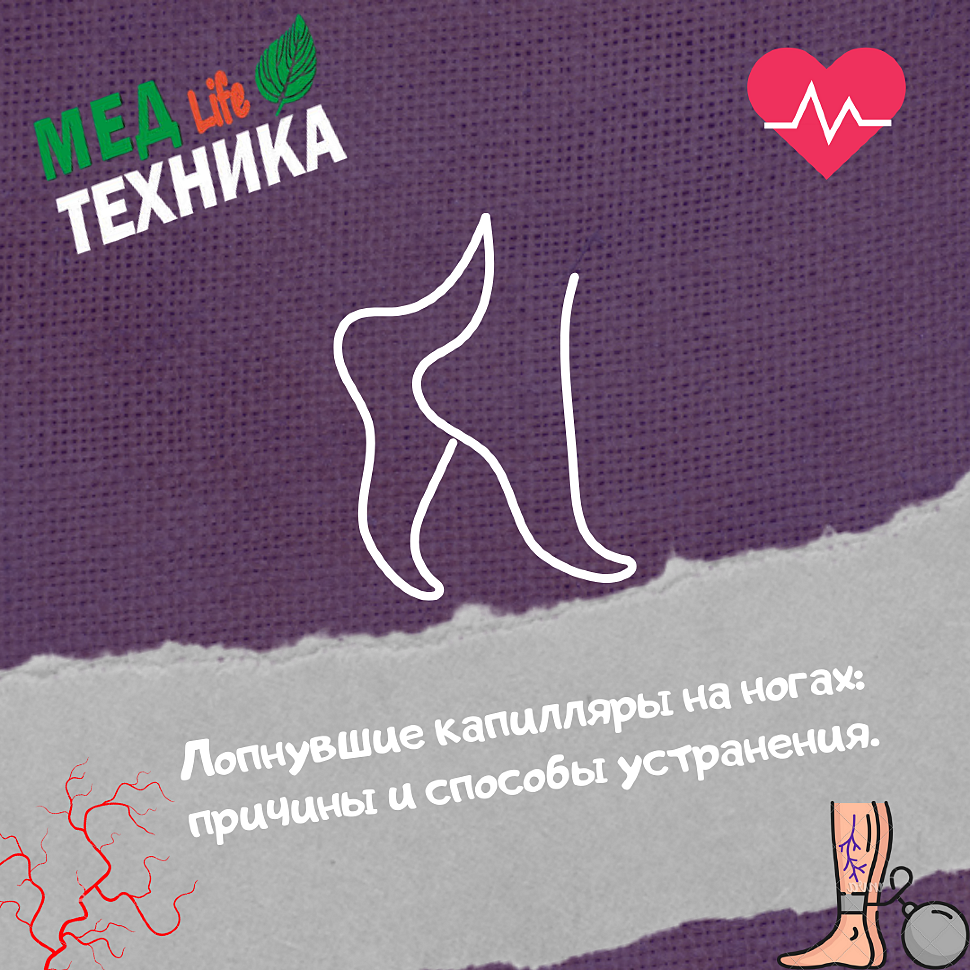 Лопнувшие капилляры на ногах: причины и способы устранения.