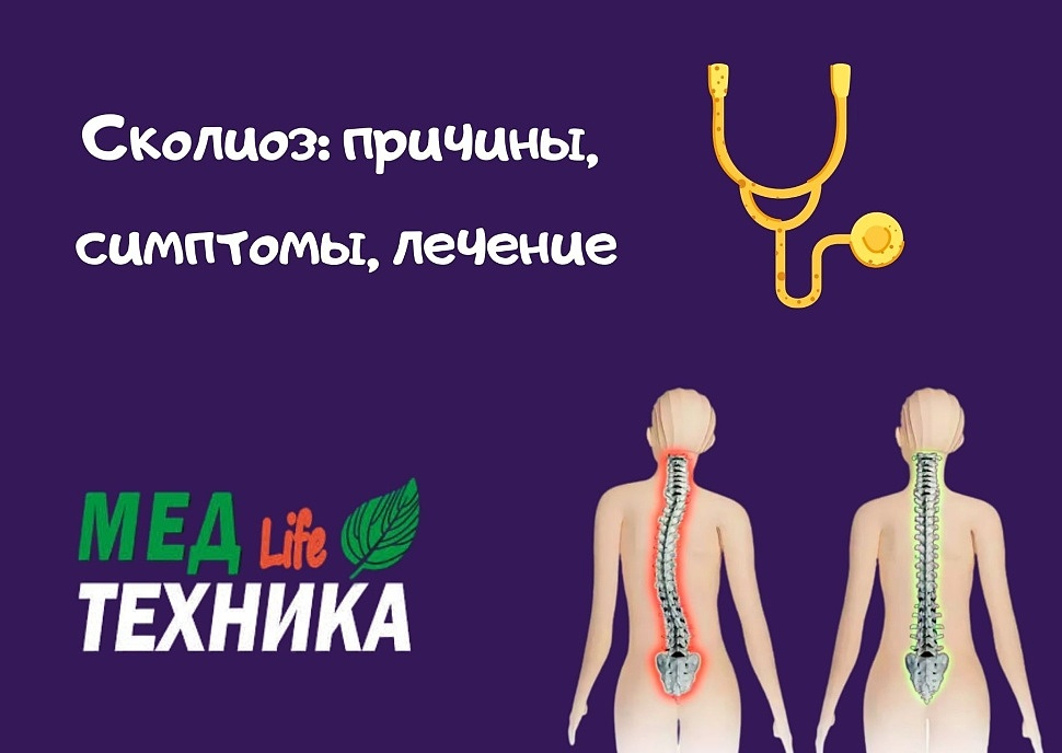 Сколиоз: причины, симптомы, лечение