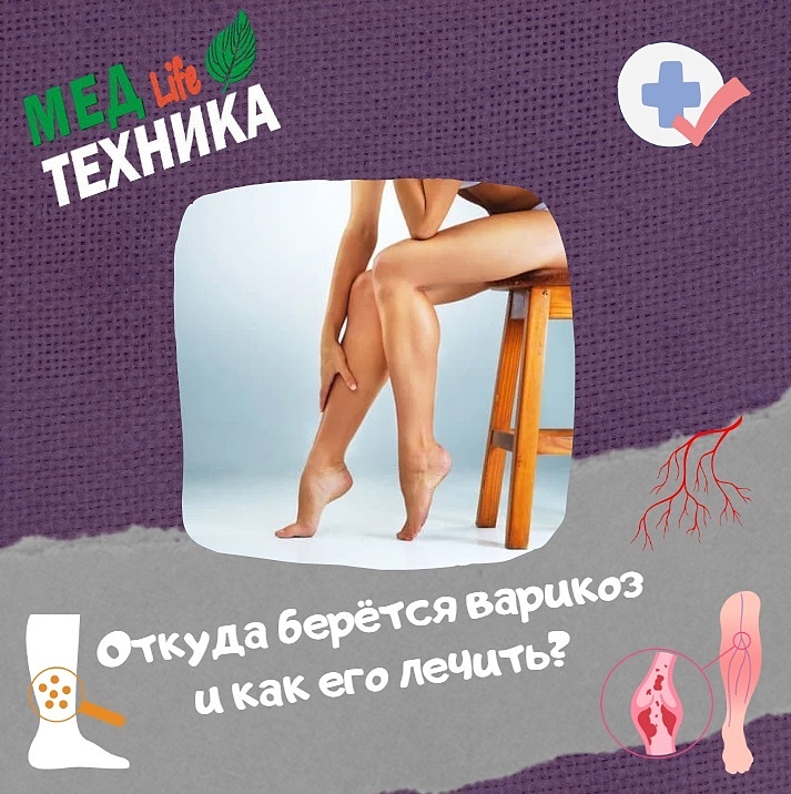 Откуда берётся варикоз и как его лечить?