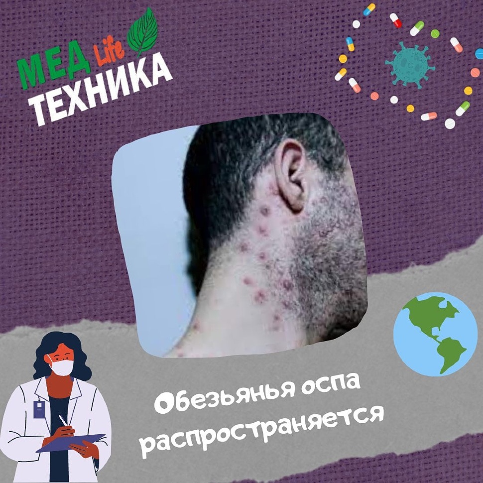 Обезьянья оспа распространяется