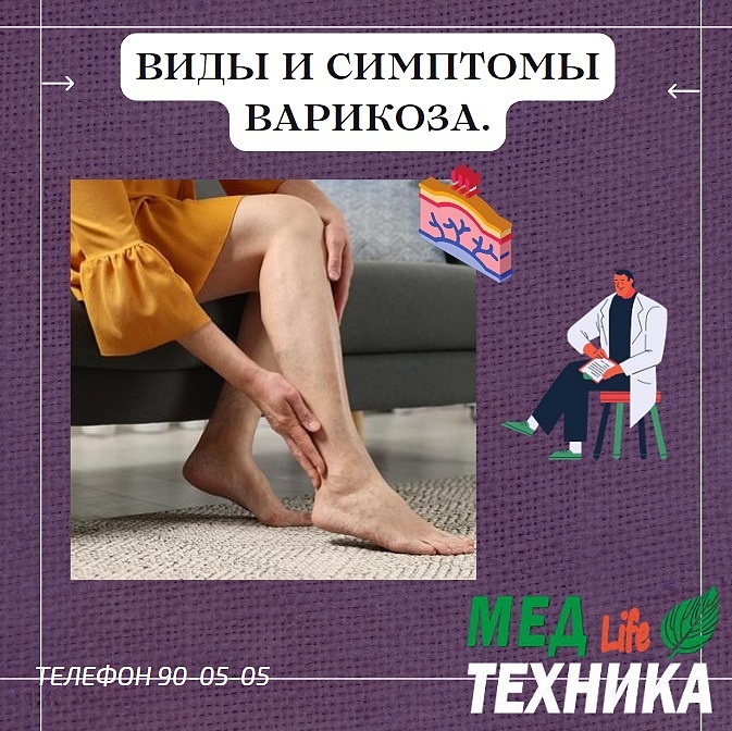 Виды и симптомы варикоза.